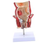 Human Pathologies of Rectum Model Easy to Use Medicals Teaching Tool Anatomical Pathologies of Medicals Teaching