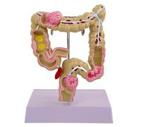 Human Pathologies of the Large Intestinal Model Human Large Intestinal Model Human Anatomical Model Medicine Teaching Aid