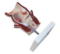 Human Rectal Hemorrhoid Lesion Anatomical Model Rectus Fissure Lesion Model, Human Anatomy, 5x Human Anortal Model 5x Anatomical Model Of Anal Hemorrhoid Fistula