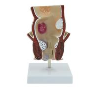 Human Rectal Pathological Anatomy Model, internal and external rectal hemorrhoids hemorrhoids lesions model, Colon Anus Sphincter Specimen for Medical Research Teaching Display.