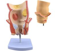 Human Rectal Pathology Demo Model, Hemorrhoidal Disease Simulation, Anorectal Acne Model with Base, Medical Anatomical Training Tool, for Clinical Education, Learning Display