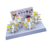 Human Skeleton Model for Anatomy Lumbar Spine 4-Stage Lesions Comparative Vertebrae Nursing Human Spine Vertebrae Anatomy Medicals Teaching Tool