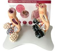 Human Smoking Lung Health Alveolar Model, Smokers Lung Model Healthy Lung Model, with Pathological Features And Accurate Anatomy Structure for The Effects Of Smoking On Lung Health