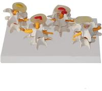 Human Spine Anatomical Model Lumbar Disc Herniation Model Human Spine Anatomical Model 4 Level Medical Lumbar Spine Normal and Pathology Combination Model