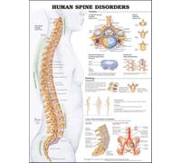 Human Spine Disorders Anatomical Chart