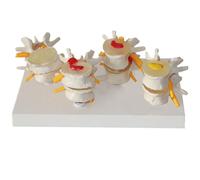 Human Spine Model - 4-Stage Diseased Lumbar Spine Comparison For Anatomy And Physiology Education