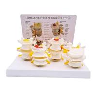 Human Spine Model, 4-Stage Diseased Lumbar Spine Comparison Model of The Stages Spinal Disc Diseases Bone Degeneration Advanced Osteoporosis