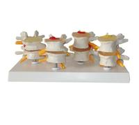 Human Spine Model,4-Stage Lumbar Vertebrae Model, Human Spine Model with English Back Card, Spine Osteoporosis 4-Stage Disease Model for Learning and Education