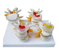 Human Spine Model - 4-Stage Pathological Lumbar Spine With Herniated Disc, Bone Degeneration & Advanced Osteoporosis, Includes English Back Card For Display