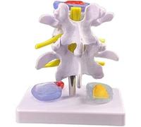 Human Spine Model - Anatomical Lumbar Disc Herniation Demonstration for Educational Use