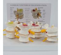 Human Spine Model, Comparative Model of 4-Stage Lesion Lumbar Spine, with English Back Card, Display Herniated Disc, Bone & Disc Degeneration, Orthopaedic Teaching Display Aids