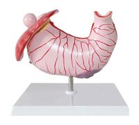 Human Stomach Anatomical Model Stomach Model Digestive System Model Educational Model Gastritis Model Gastric Lesion Model Gastric Pathology Gastritis Ulcer Medical Model for Medical Teaching