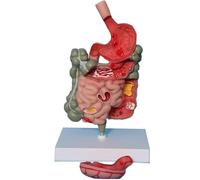 Human Stomach Anatomy Model, Intestine Pathology Model, Pathological Digestive System Model, Removerable Teaching Model,Stomach Section Large Small Intestine Medical Model Anatomy