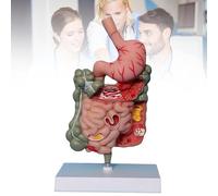 Human Stomach Anatomy Model - Pathological Digestive System with Removable Stomach Section and Large Small Intestine for Medical Learning