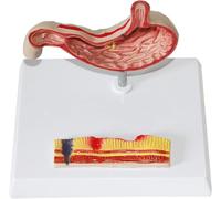 Human Stomach Perforated Stomach Pathology Model,Stomach Pathology Gastritis Ulcer, Stomach Anatomy Model, for Medicine Teaching Learning.