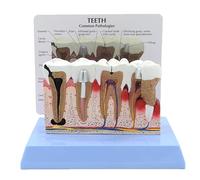 Human Teeth Dental Model Anatomy Model, With Instructions, Pathology Demonstration Dental Model, For Dentist Office Educational Learning Tool