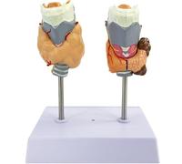 Human Thyroid pathological Anatomy Model, Magnified Thyroid Anatomy Model, Laryngeal Thyroid Thyroid Cyst Tumor Model - for Display Teaching Classroom Teaching