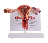 Human Uterus and Ovary Anatomical Model - Female Reproductive Organs Anatomy Model, Pathological Uterus and Ovary, Life-Size Realistic, Medical Anatomy