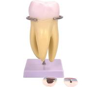 HUOYALU Molar Molar Tooth Model, Human Anatomy Enlarged Tooth Mold, Removable Caries Teeth & Dental Nerve 6 Parts Children's Dental Toy Teaching Aids Model