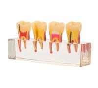 IMIKEYA Pediatric Deciduous Teeth Model with Removable Teeth for Educational Training, Realistic Oral Anatomy Resin Model with Caries Progression Visualized, for Clinical Demonstration