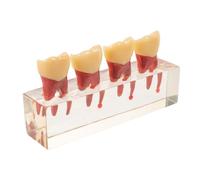 IMUSINICE Demo Model for Primary Teeth with Caries Progression Visualized, Resin Oral Anatomy Teaching Aid for Disease Teaching and Oral Health Education, Hands-on Practice Study Model