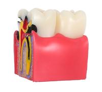Ipetboom Caries Tooth Teaching Model Resin Teeth Decay Educational Tool for Patients Dentists and Educators with Bilateral Comparative Study and Preventive Insight