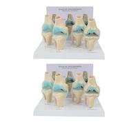 ISKDJBJG 2X Knee Kit Osteoarthritis Anatomy Model with Educational Key Card 4 Stage Knee Model Orthopedic Teaching Aids