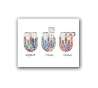 JIANGSHANDAIYOUCAIREN Canvas Painting Tooth Implant Dental Crown Posters Dentist Gift Tooth Anatomy Medical Wall Art Pictures For Dental Clinic Decor No Frame-40x50cm