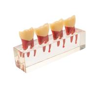 JOINPAYA Pediatric Teeth Teaching Model with Resin Oral for Clinics and Disease Teaching, Caries Progression Visualized Demo Supporting -patient Communication and Hands-on Practice
