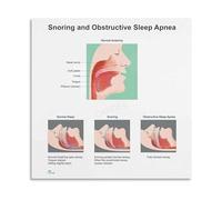KCDFDVJFBM Obstructive Sleep Apnea Poster - Education Chart for Doctor Office, Clinic, Health Classroom Decor(Framed,16x24inch(40x60cm))