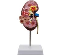Kidney Diseases Model, Kidney Pathological Model, with Digital Anatomical Location Identification, for Demonstrate the Structure and Function of the Human Kidney
