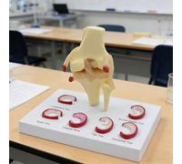 Knee Meniscus Injury Anatomy Model for Science Teaching - 6 Tear Types | Knee Meniscus Anatomy Model - Detailed Teaching Tool for Understanding 6 Types of Tears in Anatomy Education