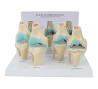Knee Pathological Model, 4 Stage Osteoarthritis Anatomical Model with Educational Key Card for Patient Education and Medical Study