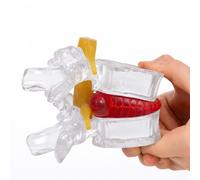 L4-L5 Lumbar Disc Anatomy Model, 1.5X Enlarged Teaching Aid, Transparent