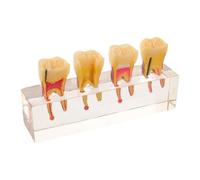 LALAFINA Teaching Model for Primary Teeth with Realistic Oral Anatomy and Caries Progression Visualized Resin Endodontic Demo for Patient Consultation and Disease Teaching