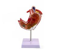 Large Pathological Stomach Anatomy Model with Ulcers Gastritis for Teaching