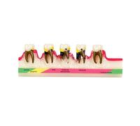 Life Size Anatomical Periodontitis Model Adult Periodontal Pathology Anatomy Model for Classroom Teaching Demonstration Clinic Patient Education Tool