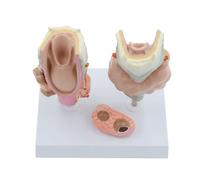 Life-Size Pathological Laryngeal and Thyroid Anatomy Model Throat Organ with Disease Representation Clinical Study Human Torso Model