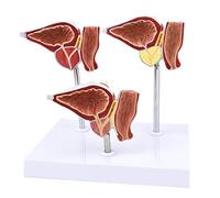 Life Size Prostate Model - Normal And Lesion Presentation Prostate Compare Models - PVC Material Human Anatomy Science Models - for Study Display Medical Teaching Model