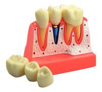 Lipfer Dental Implant Model - 4 Times Removable Analysis Crown Bridge Demonstration Teeth Model Dental Implant Analysis Tooth Model for Learning and Education