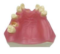Lipfer Dental Typodont Teeth Model with Missing Implant Practice Overdenture Restoration Demo for Study Teach Lower Jaw Removable Gingiva