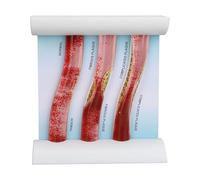 Lipoprotein LDL Blood Vessel Model, Low Density Lipoprotein Anatomical Teaching Tool, Three - Stage Artery Plaque Progression Display with to Diseased States for Medical