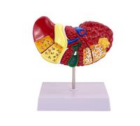 liyoe Liver Model Pathological Liver Model for Common Pathologies, Liver Model Human Anatomy Doctor Office Anatomy Model