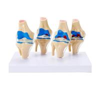 LKYLVEE Human Four-Stage Pathological Knee Joint Model - Knee Joint Anatomy Model - for Orthopaedic Study Teaching Display,White,6inch