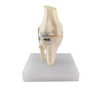 LKYLVEE Single Condyle Knee Joint Model - Total Knee Replacement Model - Anatomical Teaching Tool for Patient Education and Study,A,15cm