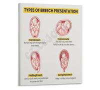 LLBOGRGGN Breech Fetal Positions Poster Diagnosis and Types Chart for Emergency Obstetrics and Training Programs Canvas(Framed,08x12inch(20x30cm))