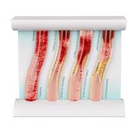 Lobamop Vascular Disease Teaching and Training Tool, 4-Stage LDL Cholesterol Blood Vessel Model