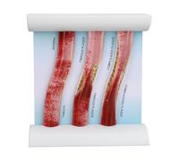 Low Density Lipoprotein (LDL) Blood Vessel Model for Education - Demonstrates Vascular Obstruction, Made from Durable PP and HIPS Materials