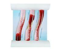 Low-Density Lipoprotein LDL Blood Vessel Model for Medical Patient Doctor Teaching