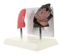 LRXIYODE Lung Anatomy Model Teaching Set - Normal and Smoking Lung Comparison Pathological Model for Medical Education and Health Awareness in Clinical and Academic Use
